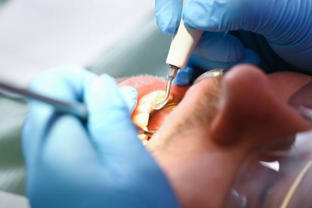 Best Emergency Tooth Extraction in Moreauville, LA