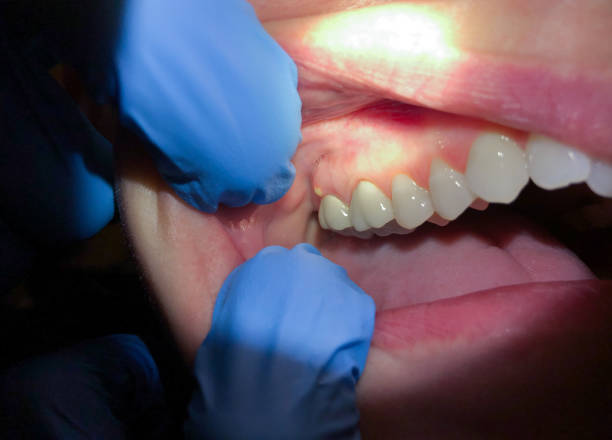 Best Same-Day Emergency Dentist in Moreauville, LA